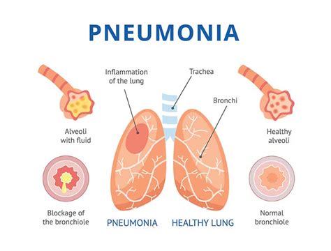 pulmonia and pneumonia|Pneumonia .